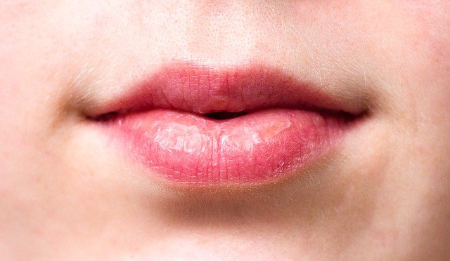 Lèvres gercées : que faire ?